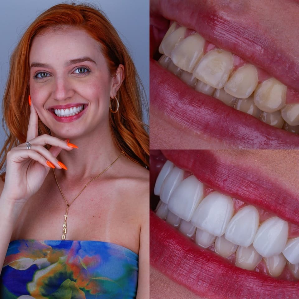 Antes e depois com facetas de resina híbrida