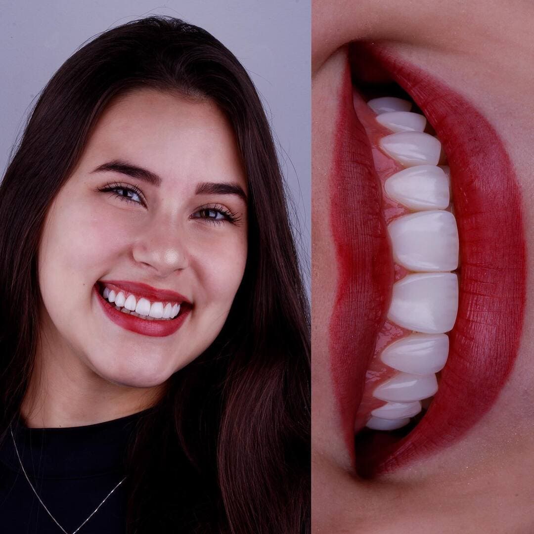 Facetas de resina, híbrida ou porcelana? Qual a melhor?