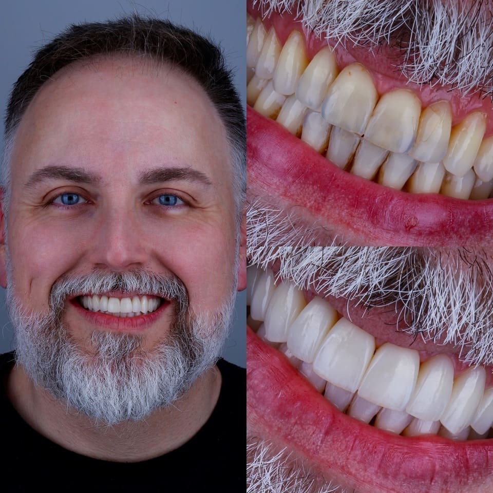 facetas-porcelana-lentes-de-contato-porcelana-curitiba-08jpeg