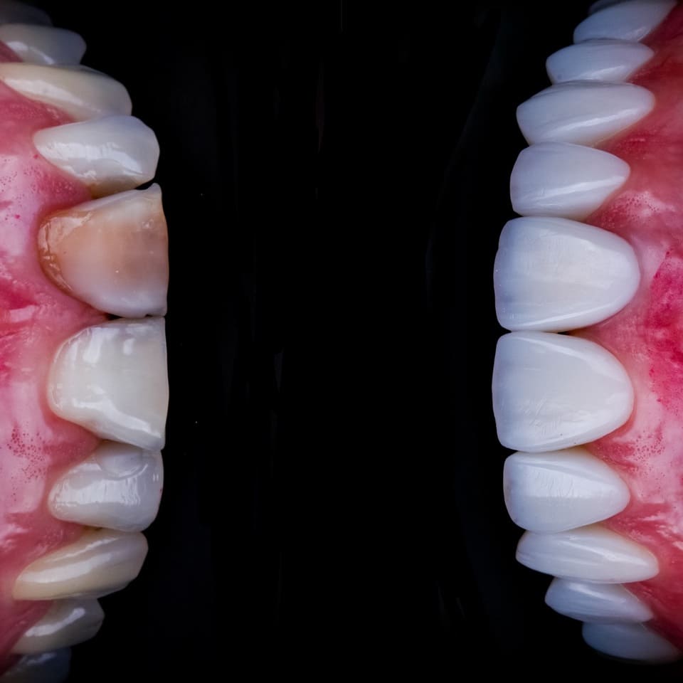 facetas-resina-lentes-dentais-resina-blanvur-curitiba-07