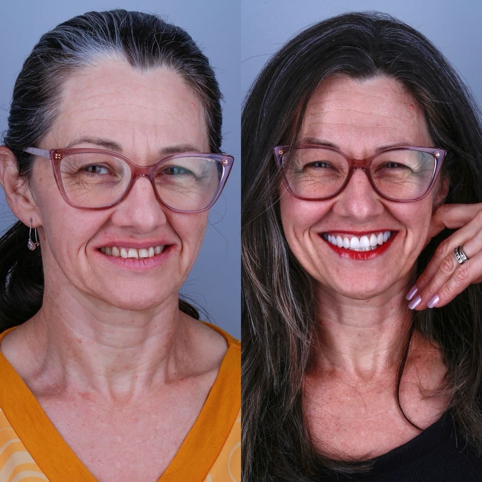 lente-dente-valor-curitiba-11