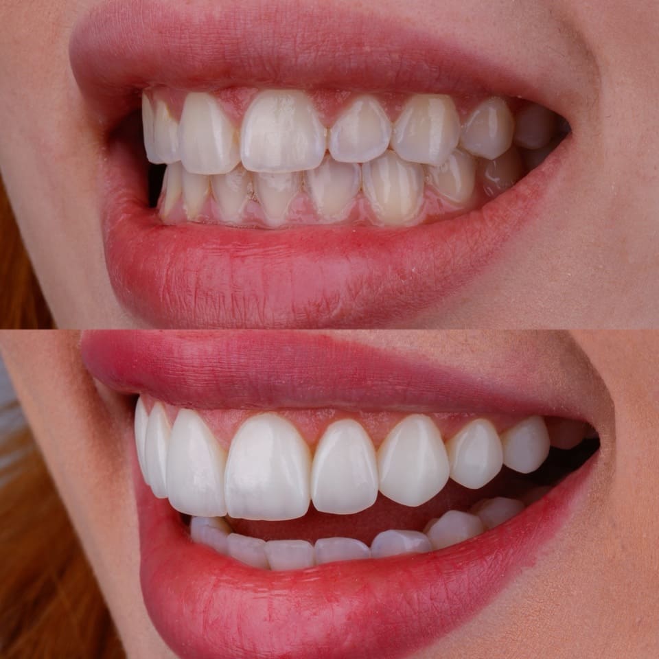 naturalidade-facetas-resina-06