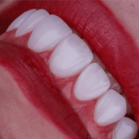 Caso de lentes dentais com naturalidade em Curitiba, na clínica Blanvur