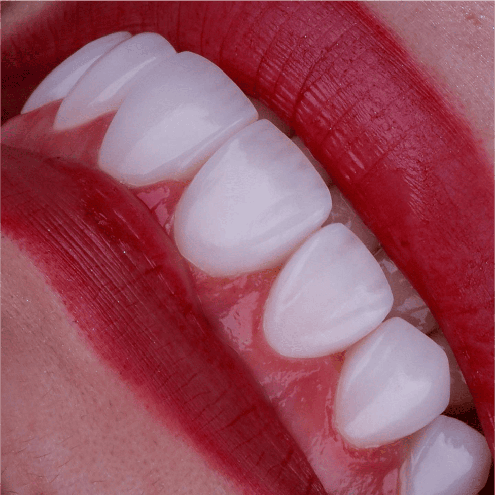 Caso de lentes dentais com naturalidade em Curitiba, na clínica Blanvur