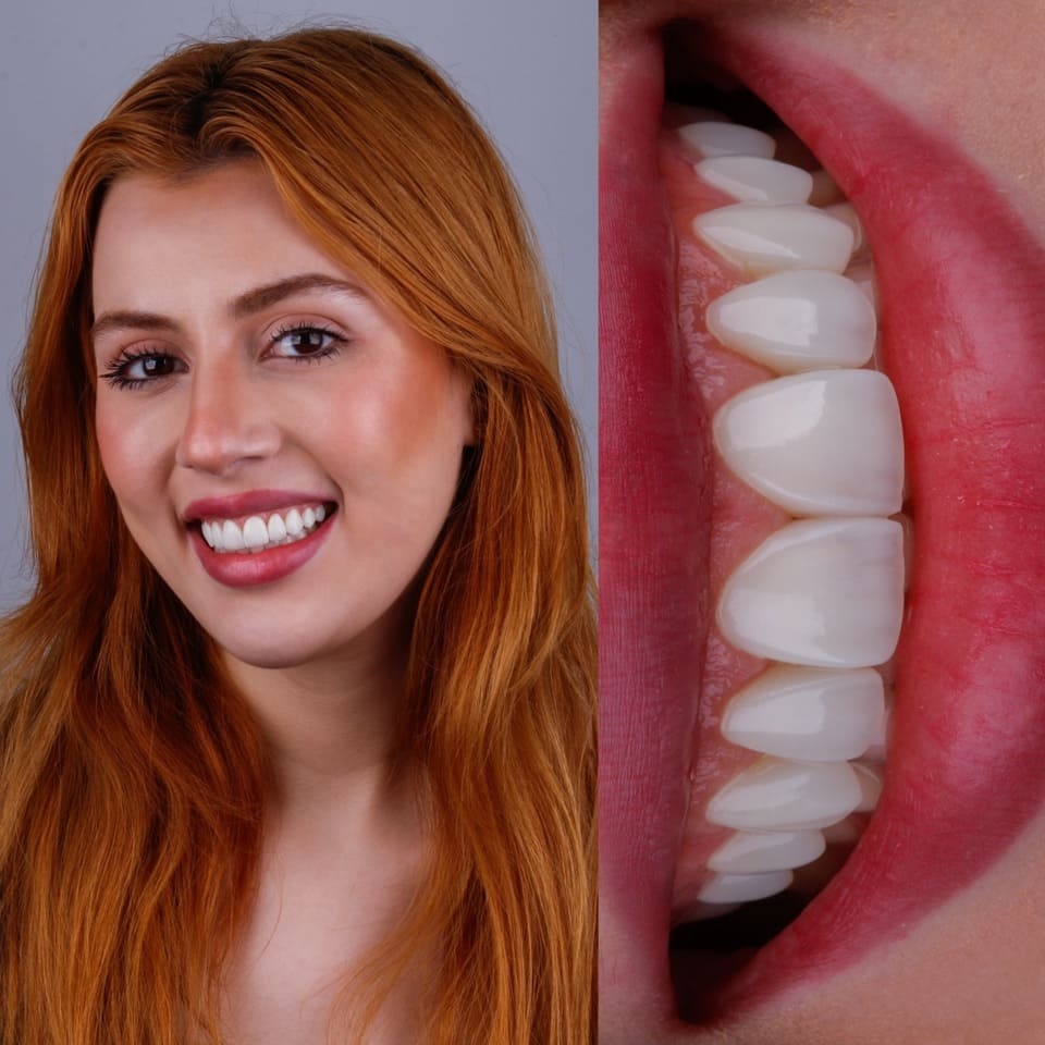 sorriso-natural-antes-e-depois-lente-hibrida-blanvur-curitiba-03