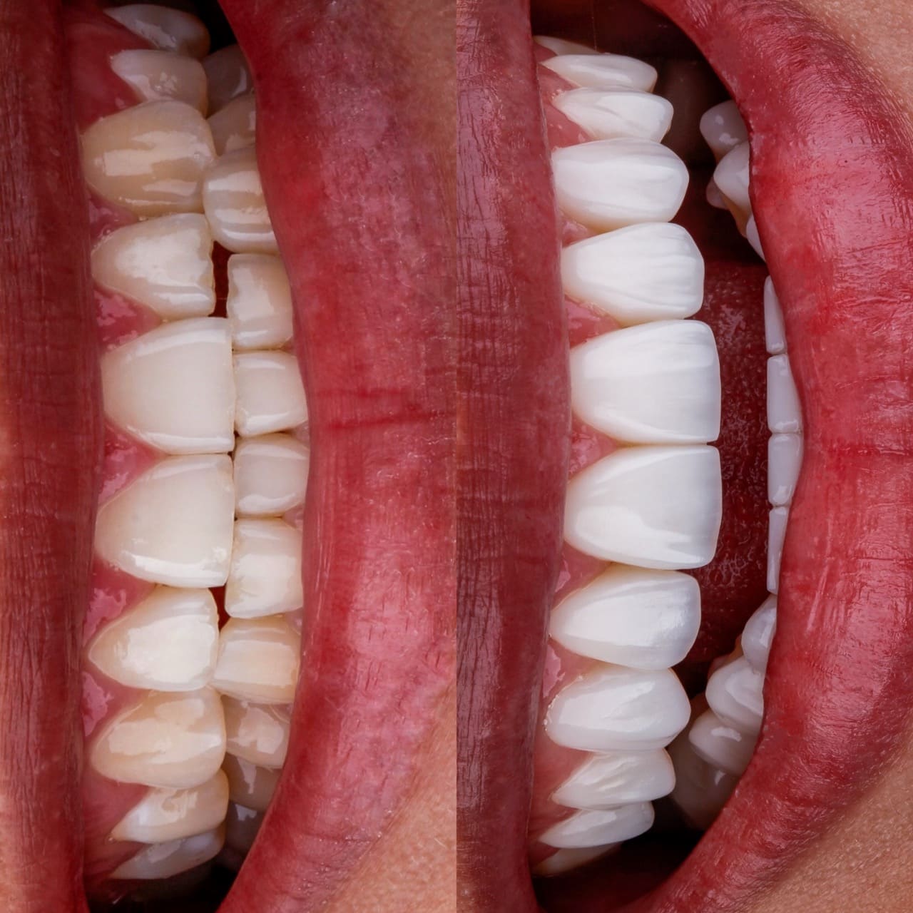 Antes e depois com facetas de resina híbridas e sorriso natural, realizado na clínica Blanvur em Curitiba.