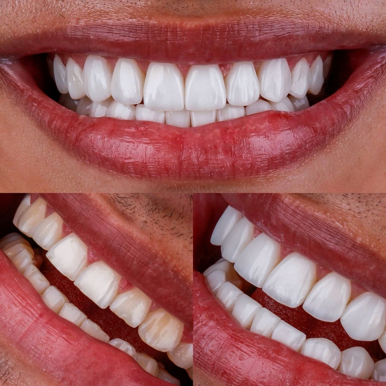 lentes-contato-dental-resina-porcelana-hibrida